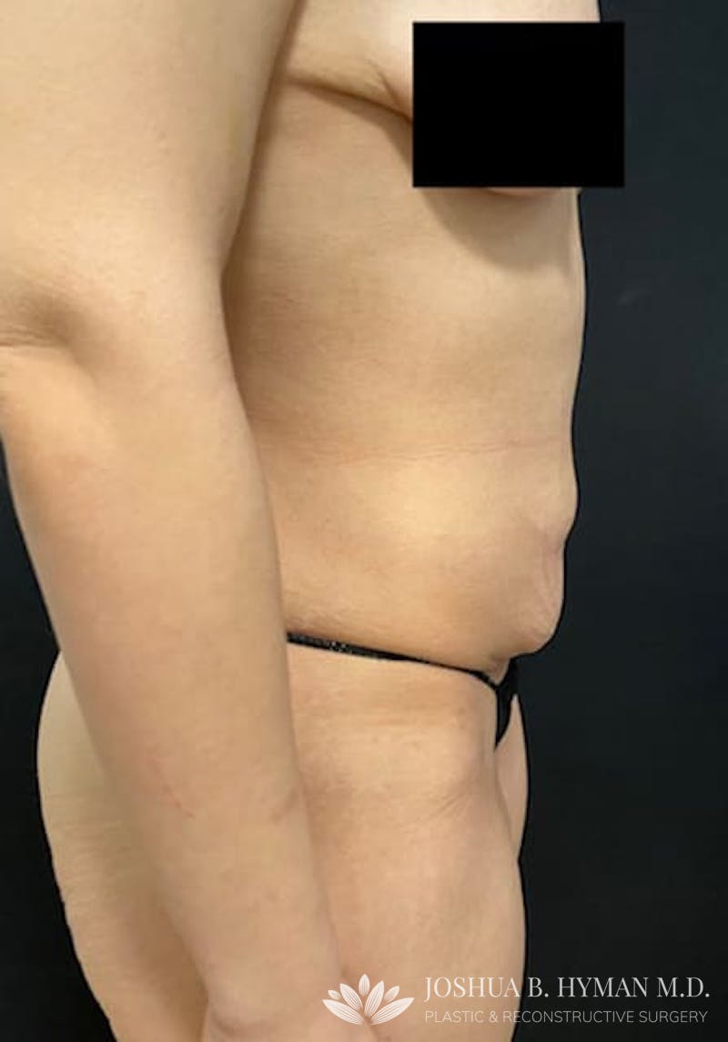 Abdominoplasty Before & After Gallery - Patient 58232405 - Image 3