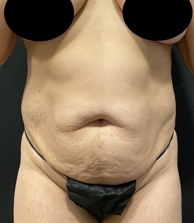 Abdominoplasty Before & After Gallery - Patient 58232408 - Image 1