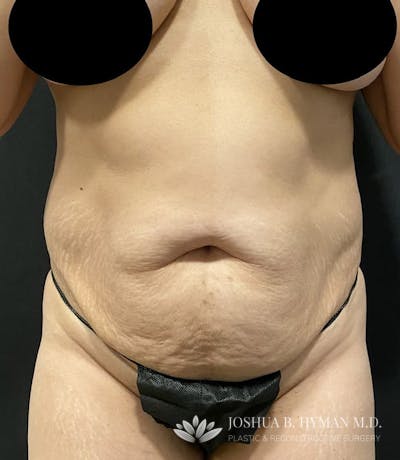 Abdominoplasty Before & After Gallery - Patient 58232408 - Image 1