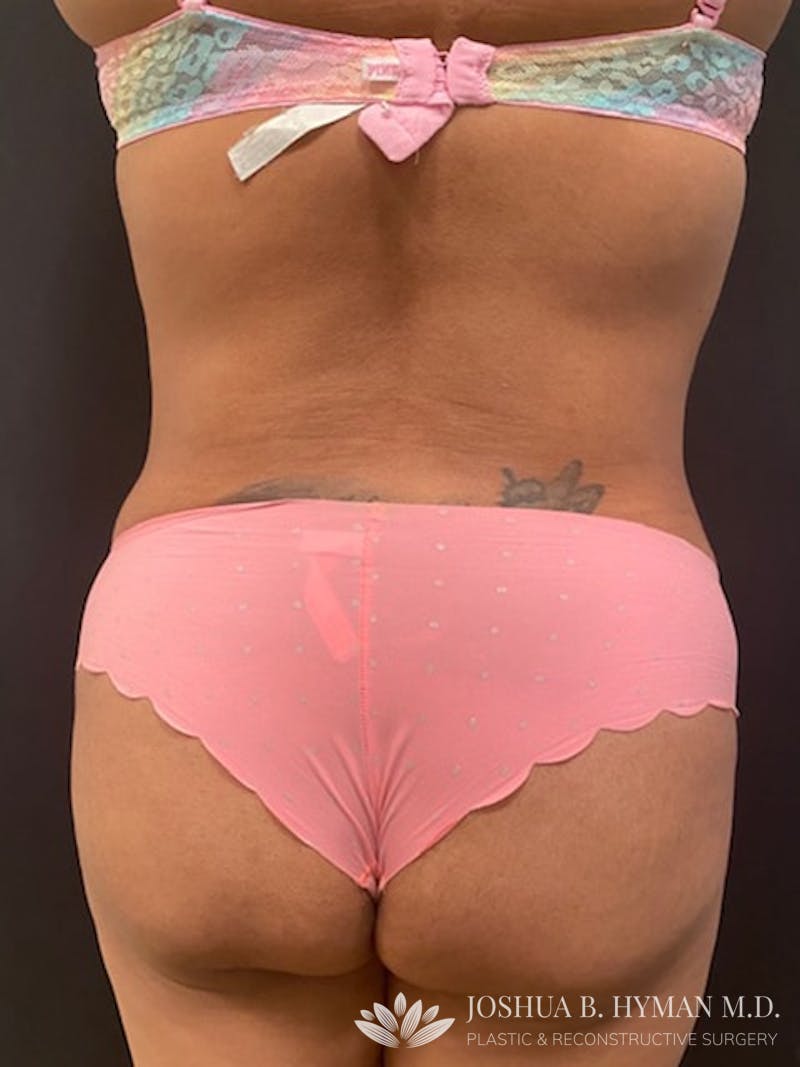 Liposuction Before & After Gallery - Patient 58232407 - Image 2