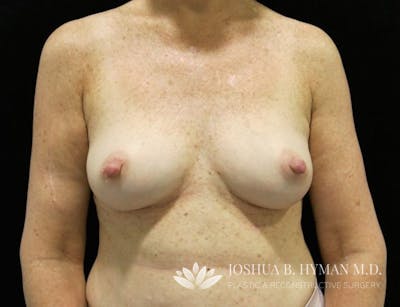 Breast Augmentation Before & After Gallery - Patient 58232413 - Image 1
