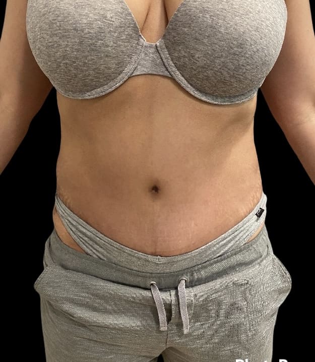 Abdominoplasty Before & After Gallery - Patient 58232408 - Image 2