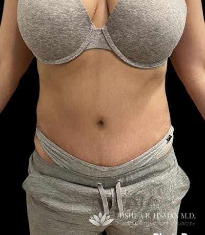Abdominoplasty Before & After Gallery - Patient 58232408 - Image 2