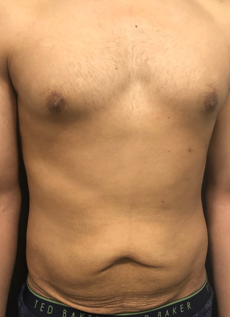 Abdominoplasty Before & After Gallery - Patient 58232414 - Image 1