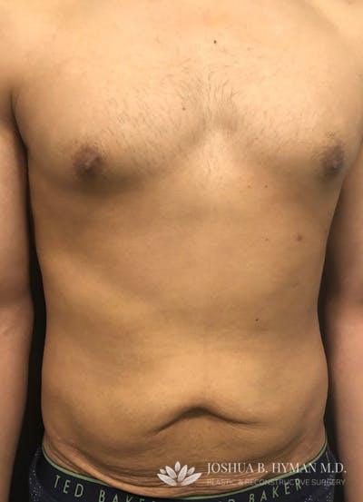 Abdominoplasty Before & After Gallery - Patient 58232414 - Image 1