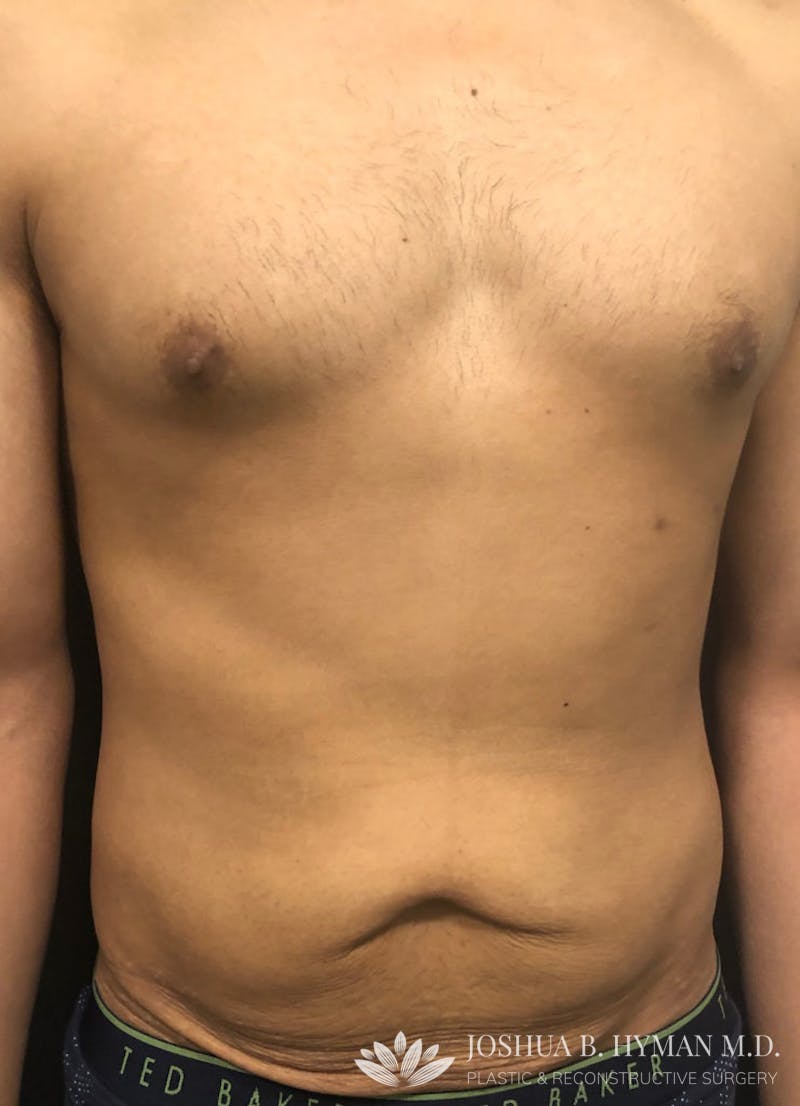 Abdominoplasty Before & After Gallery - Patient 58232414 - Image 1