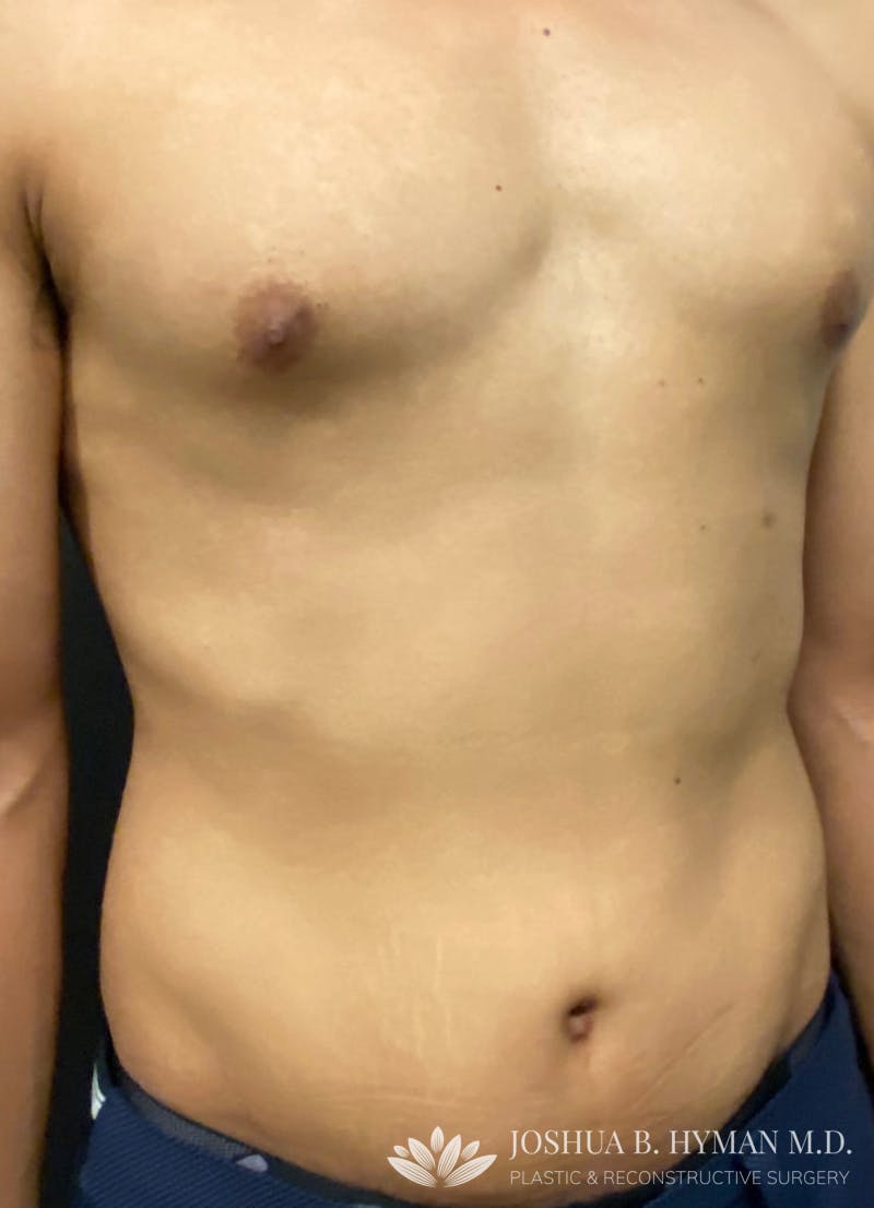Abdominoplasty Before & After Gallery - Patient 58232414 - Image 2