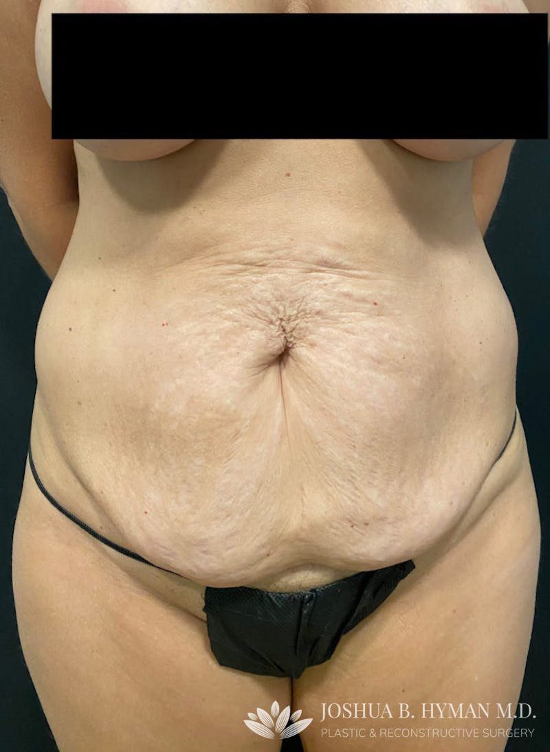 Abdominoplasty Before & After Gallery - Patient 58232416 - Image 1
