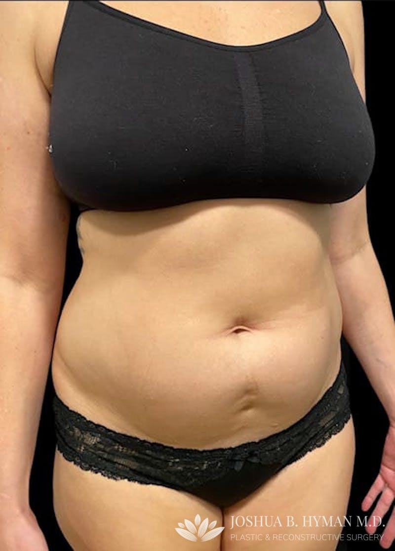 Liposuction Before & After Gallery - Patient 58232417 - Image 1