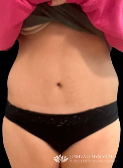 Abdominoplasty Before & After Gallery - Patient 58232416 - Image 2