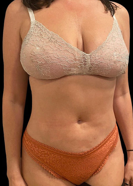 Liposuction Before & After Gallery - Patient 58232417 - Image 2