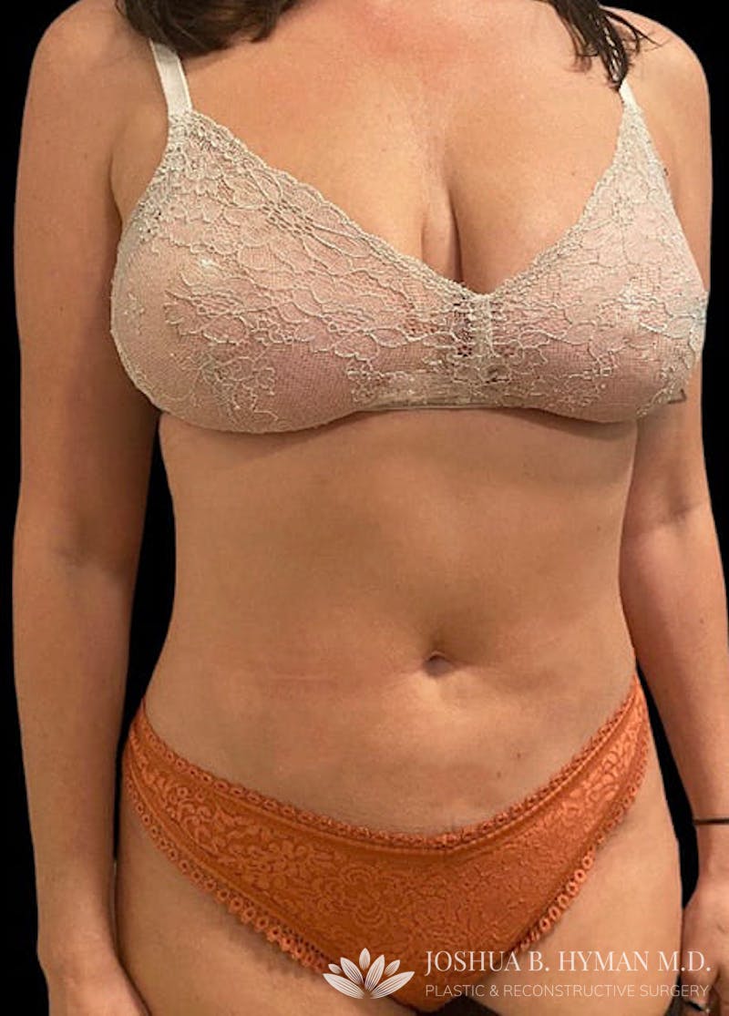 Liposuction Before & After Gallery - Patient 58232417 - Image 2
