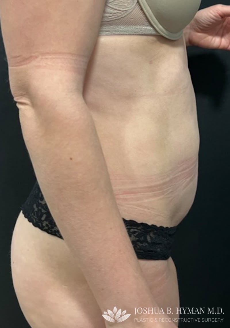 Liposuction Before & After Gallery - Patient 58232425 - Image 2