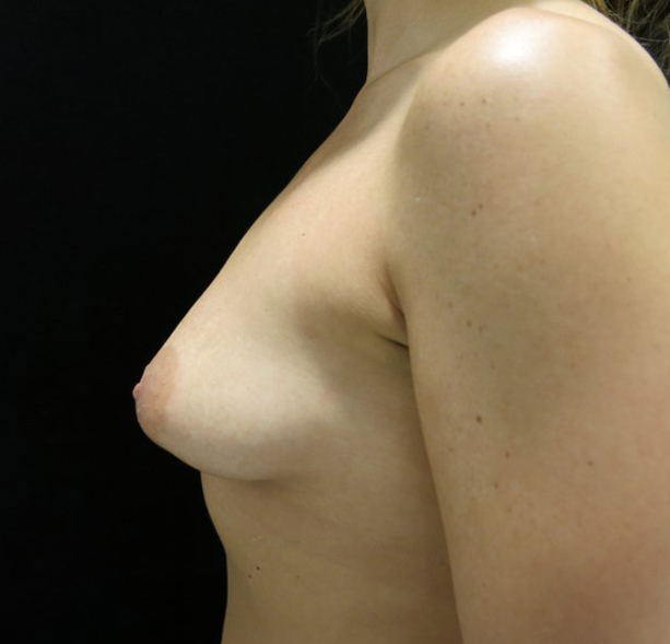 Breast Augmentation Before & After Gallery - Patient 58232762 - Image 3