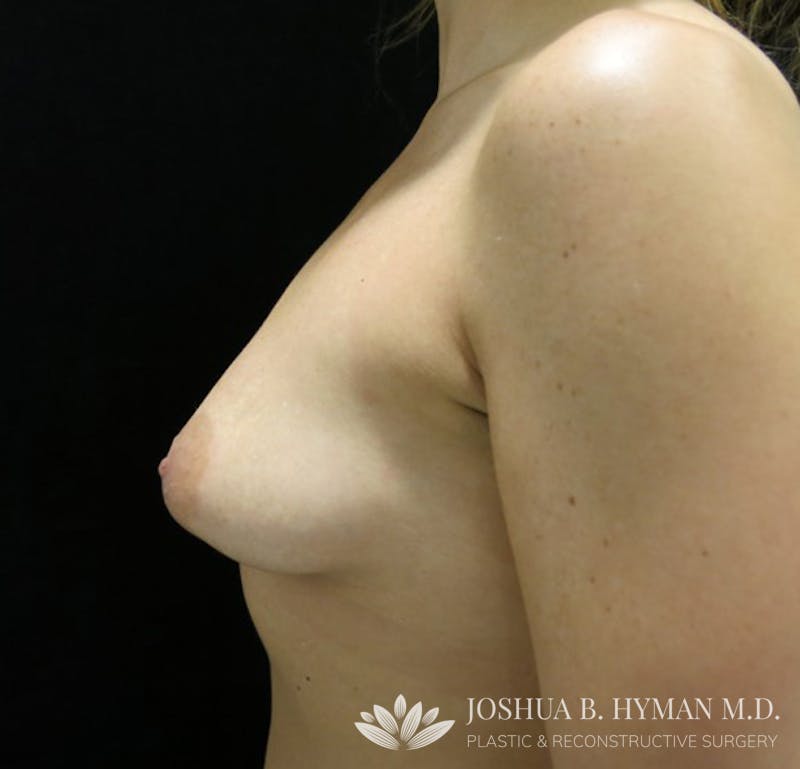 Breast Augmentation Before & After Gallery - Patient 58232762 - Image 3