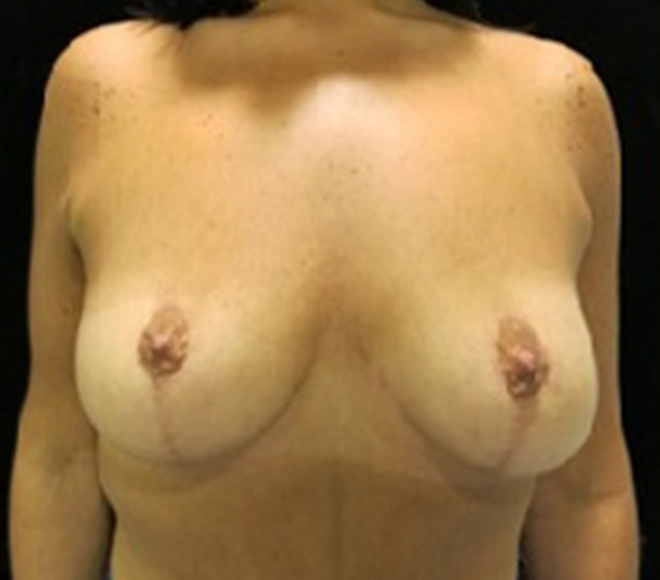 Breast Reduction Before & After Gallery - Patient 58232244 - Image 2