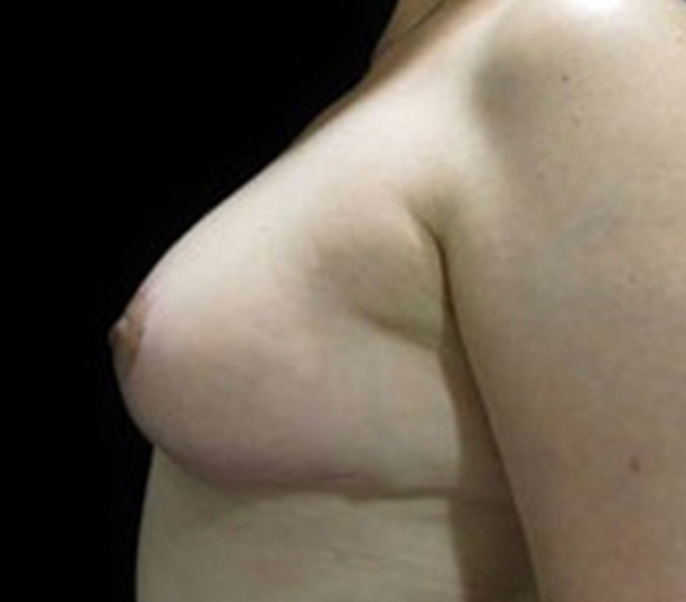 Breast Reduction Before & After Gallery - Patient 58232242 - Image 2