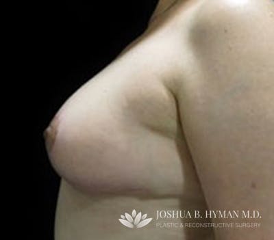 Breast Reduction Before & After Gallery - Patient 58232242 - Image 2