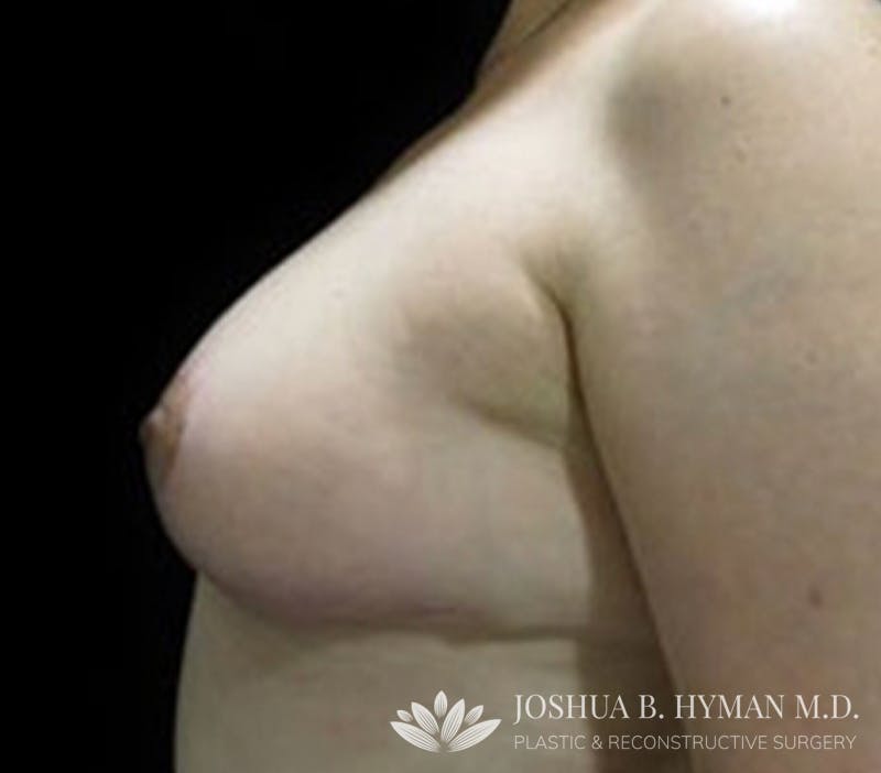 Breast Reduction Before & After Gallery - Patient 58232242 - Image 2