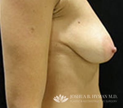 Breast Lift Before & After Gallery - Patient 58232279 - Image 1