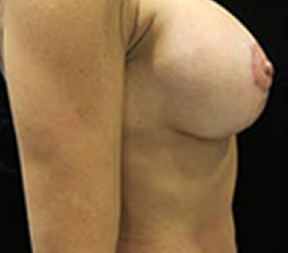 Breast Lift Before & After Gallery - Patient 58232279 - Image 2