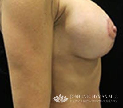 Breast Lift Before & After Gallery - Patient 58232279 - Image 2