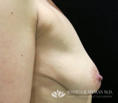 Breast Lift Before & After Gallery - Patient 58232263 - Image 1