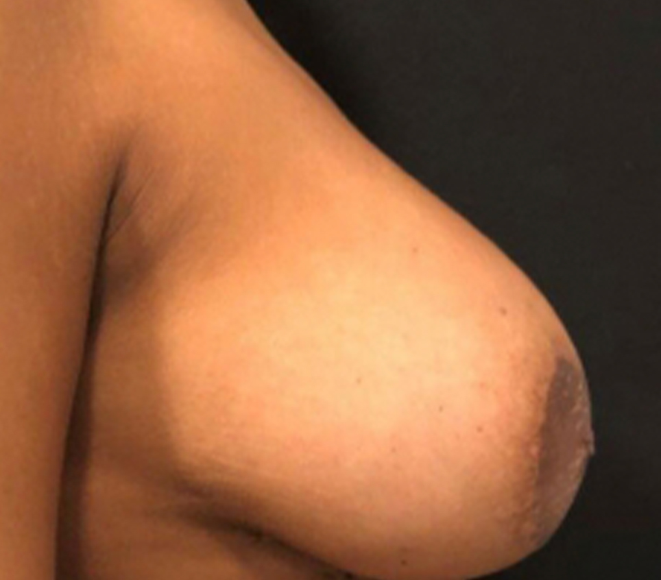 Breast Lift Before & After Gallery - Patient 58232260 - Image 1