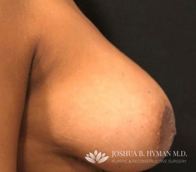 Breast Lift Before & After Gallery - Patient 58232260 - Image 1