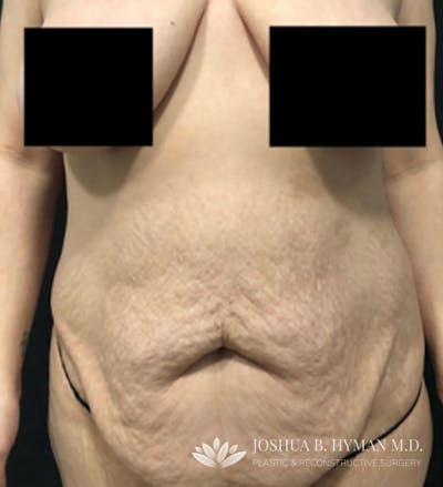 Abdominoplasty Before & After Gallery - Patient 58232341 - Image 1