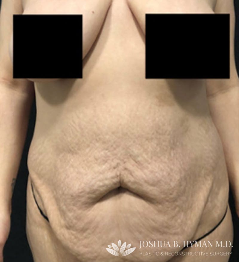 Abdominoplasty Before & After Gallery - Patient 58232341 - Image 1