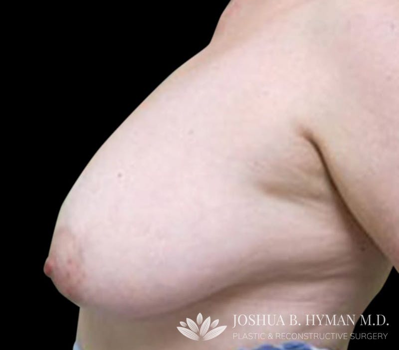 Breast Reduction Before & After Gallery - Patient 58232242 - Image 1