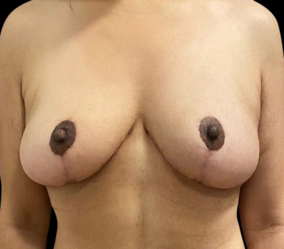 Breast Reduction Before & After Gallery - Patient 58232239 - Image 2