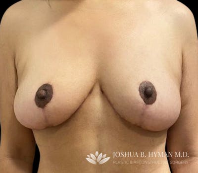 Breast Reduction Before & After Gallery - Patient 58232239 - Image 2