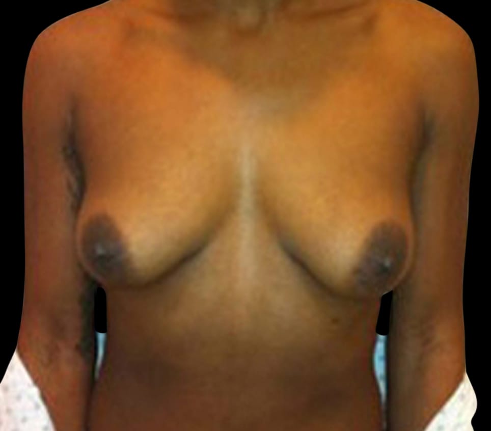 Breast Lift Before & After Gallery - Patient 58232276 - Image 1