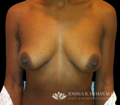 Breast Lift Before & After Gallery - Patient 58232276 - Image 1