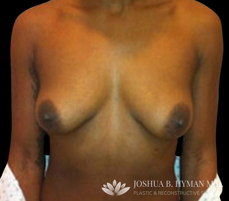 Breast Lift Before & After Gallery - Patient 58232276 - Image 1