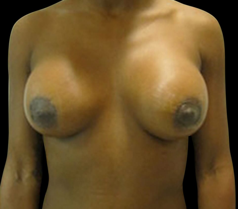 Breast Lift Before & After Gallery - Patient 58232276 - Image 2