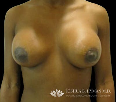 Breast Lift Before & After Gallery - Patient 58232276 - Image 2