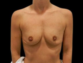 Breast Augmentation Before & After Gallery - Patient 58232291 - Image 1