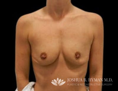 Breast Augmentation Before & After Gallery - Patient 58232291 - Image 1