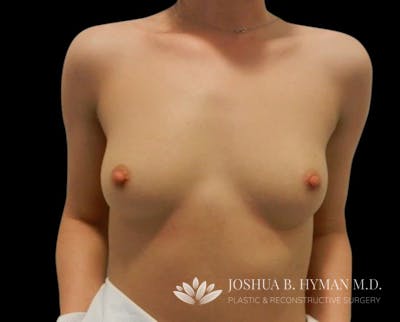 Breast Augmentation Before & After Gallery - Patient 58232336 - Image 1