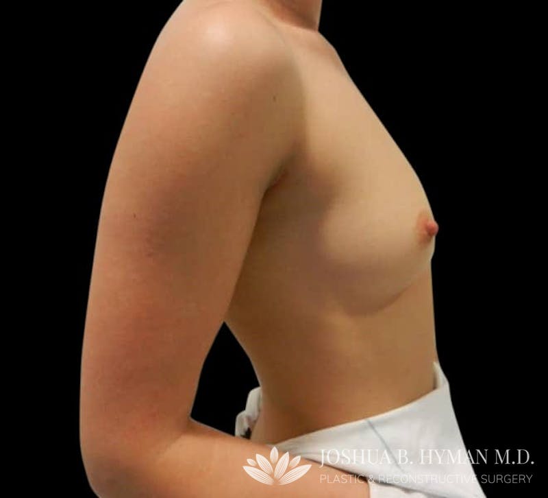 Breast Augmentation Before & After Gallery - Patient 58232336 - Image 3