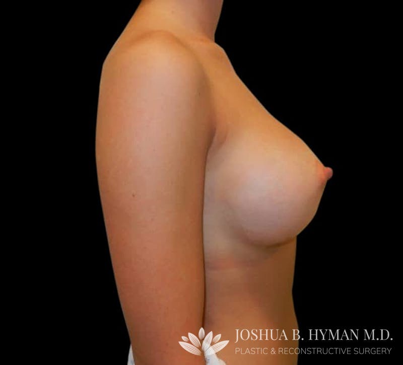 Breast Augmentation Before & After Gallery - Patient 58232336 - Image 4