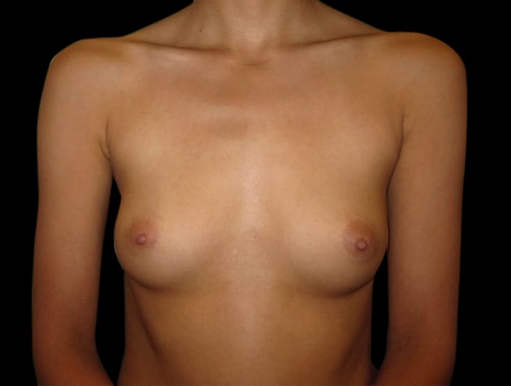 Breast Augmentation Before & After Gallery - Patient 58232362 - Image 1