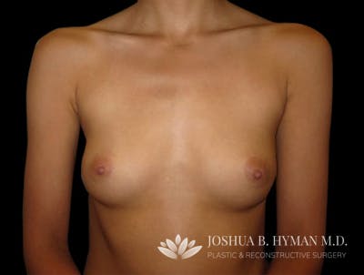 Breast Augmentation Before & After Gallery - Patient 58232362 - Image 1