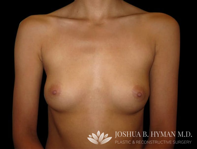 Breast Augmentation Before & After Gallery - Patient 58232362 - Image 1