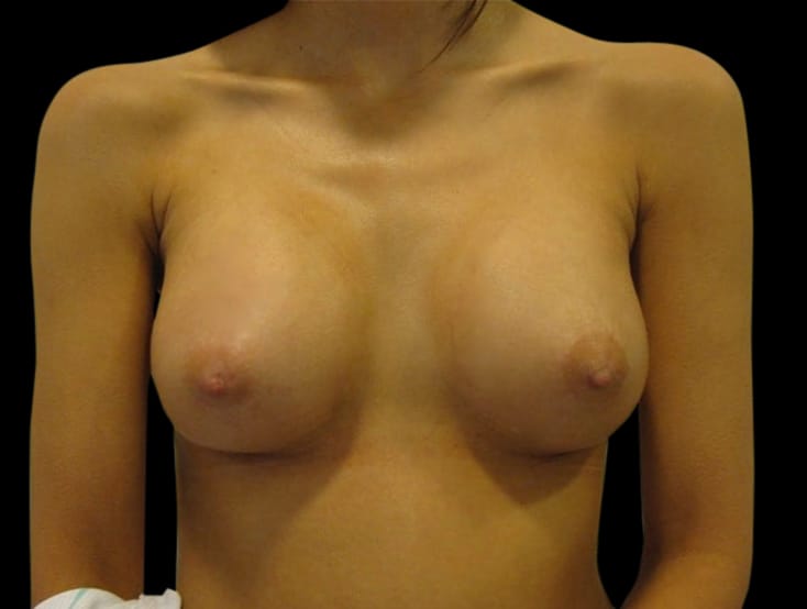 Breast Augmentation Before & After Gallery - Patient 58232362 - Image 2