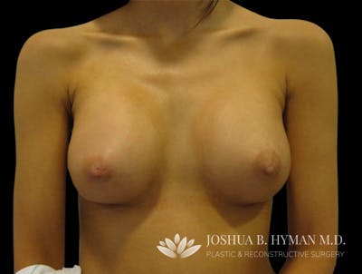 Breast Augmentation Before & After Gallery - Patient 58232362 - Image 2
