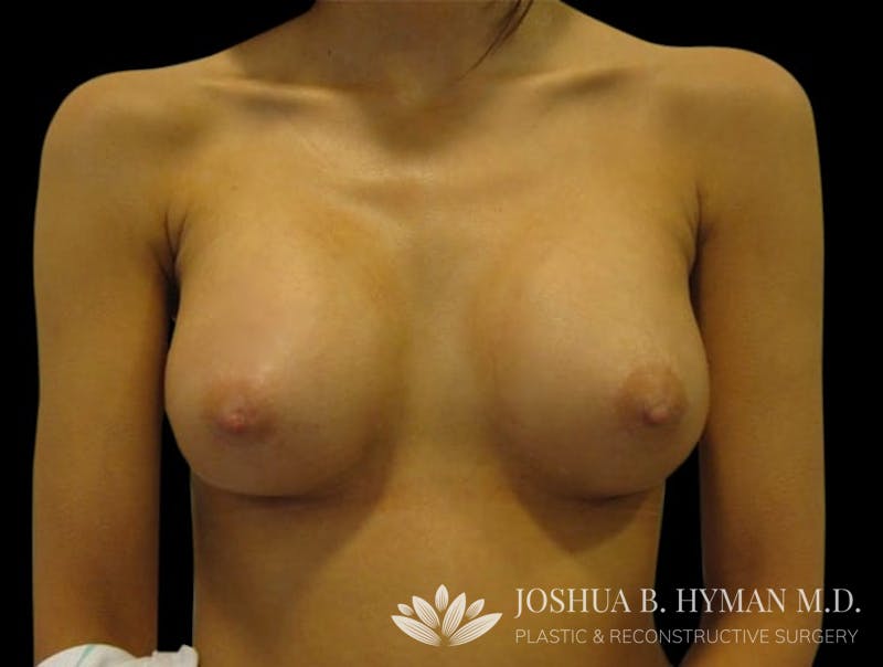 Breast Augmentation Before & After Gallery - Patient 58232362 - Image 2